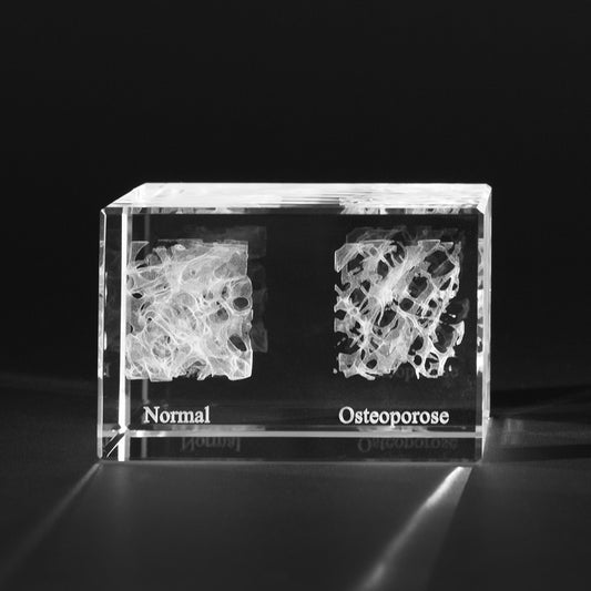 3D Knochenmodell Knochen vom Mensch mit Osteoporose, Medizinische Motive